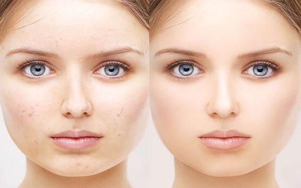 激光美白的美白效果好吗明显吗激光美白做几次才能永久变白