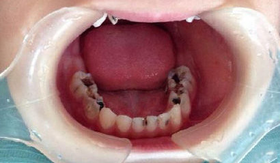 口腔知识——儿童龋齿篇