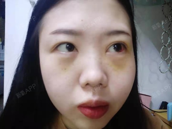 眼睛下面眼袋原来的地方有点浮肿,我都不经常出门了,_圈子-新氧美容