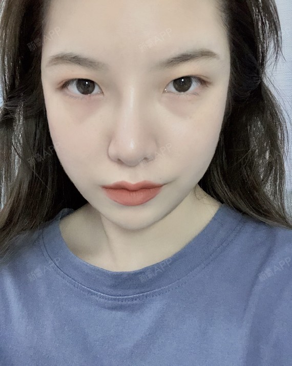 鼻子恢复情况很好,也很适合我,是我喜欢的样子,拍照花了个 淡妆,鼻影