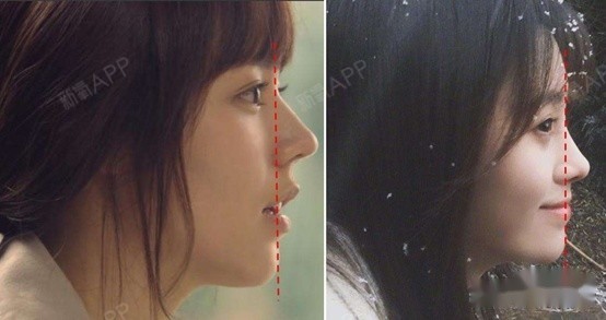 正面看,还有鞋拔子脸的既视感. 凹陷过深,也容易显得苦相.