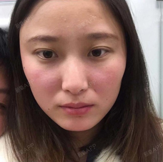 瘦脸针术后第十天啦可能是因为我的脸盘子太大了吧