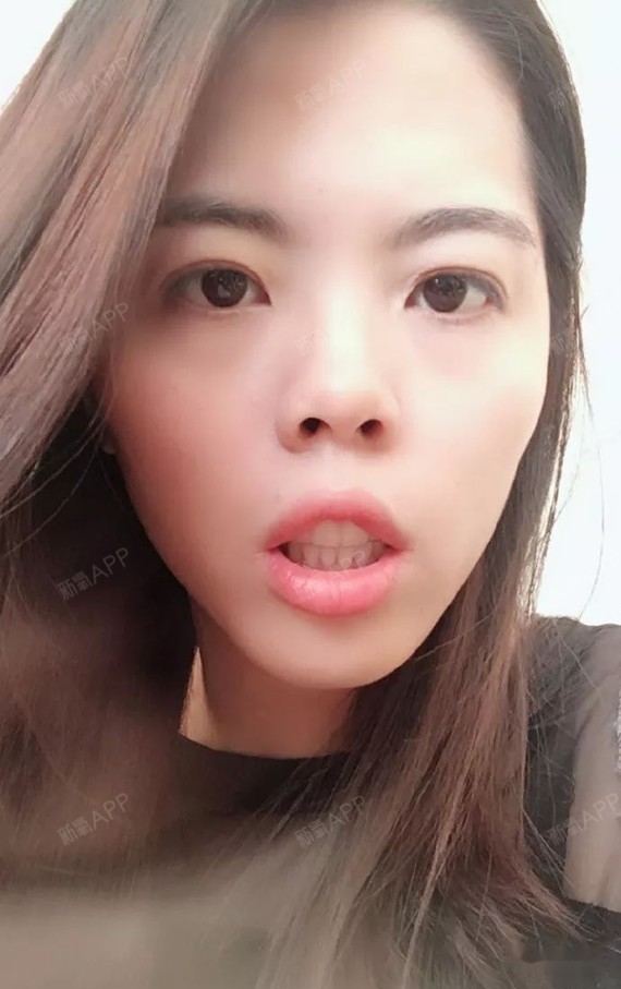 戴牙套会上瘾,嘴凸下巴后缩,484天毕业,自己满意了