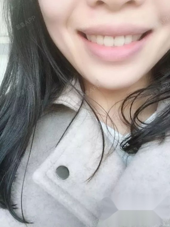 严重骨性+只拔智齿+缝隙较大+牙套收获这辈子