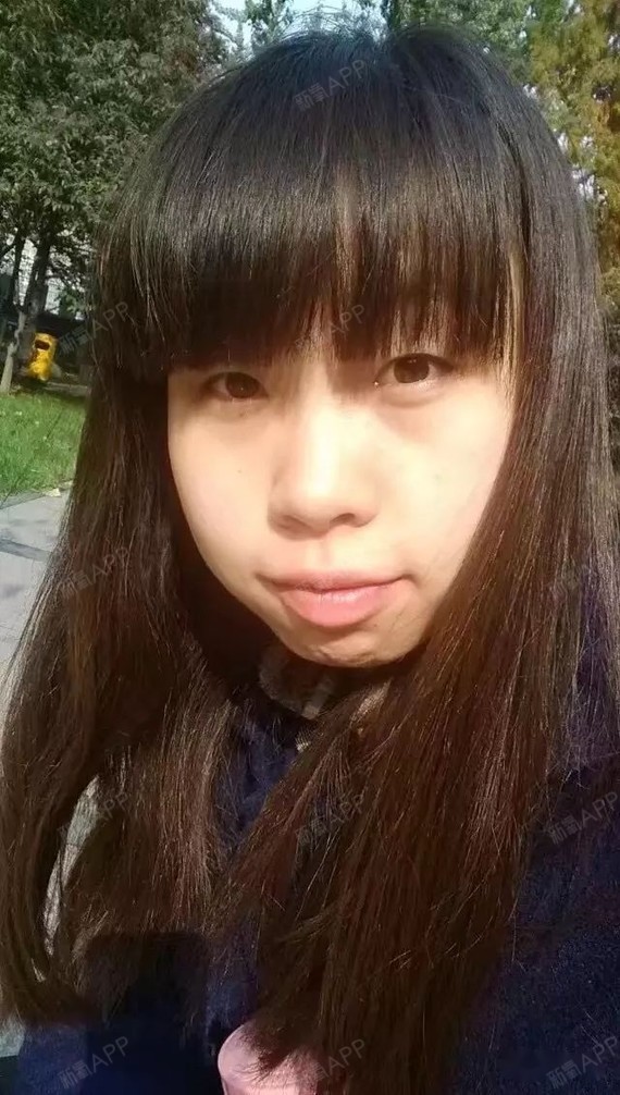 嘴唇突出显很厚,脸圆呼呼的,鼻子也不高.戴牙套后,嘴不凸了,脸也瘦了