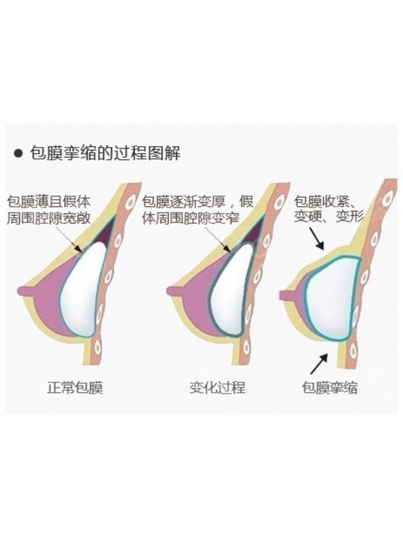 题上,其实丰胸手术里最不可预见的一种情况叫做包膜挛缩.