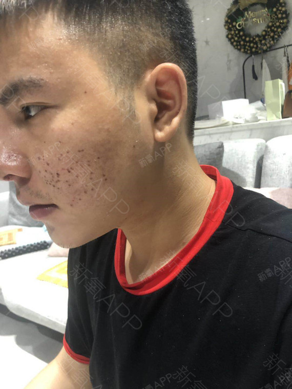 脸上的伤口都已经结痂了,现在看上去有点惨不忍睹有那_圈子-新氧美容