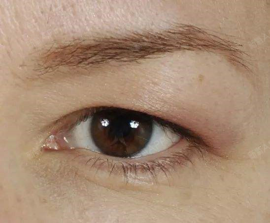 【为什么我的双眼皮会下垂?】