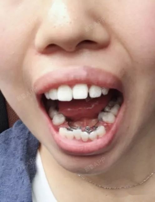 严重骨性戴的舌侧牙套拔牙四颗半年牙齿矫正变化明显