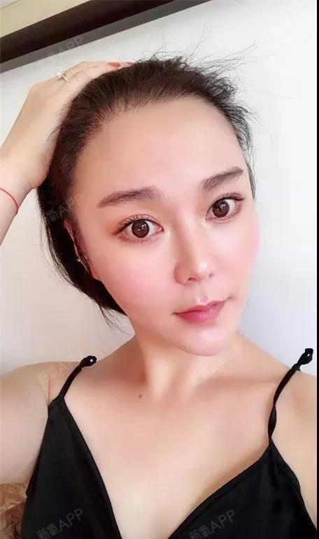 发际线种植术后1年 | 银盆大脸终于修炼成了邻家幼_圈子-新氧美容整形