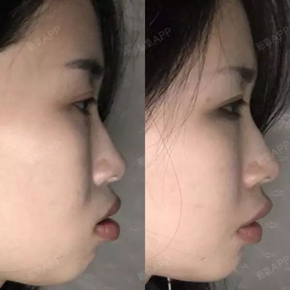 从小因为牙齿被同学嘲笑起外号,深覆合整完牙后男朋友说比以前好看了
