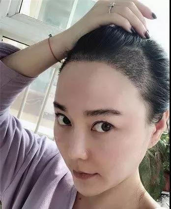 发际线种植术后1年 | 银盆大脸终于修炼成了邻家幼_圈子-新氧美容整形
