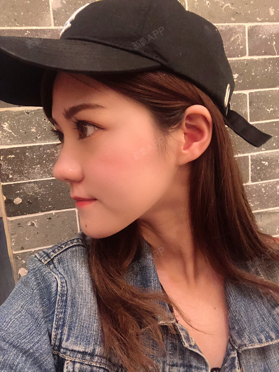 激光祛斑好不好_效果图_独孤寒激光祛斑术后