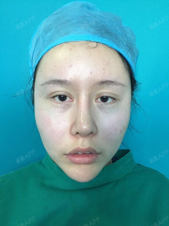 为什么不建议求美者自体脂肪丰眉弓