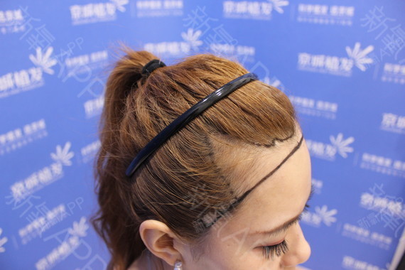 【发际线种植 额角种植】