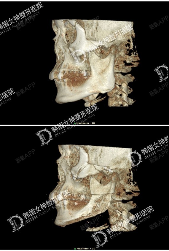 【韩国女神整形医院】-颧骨,下颌角,下巴截骨前移,劈外板 术后150天