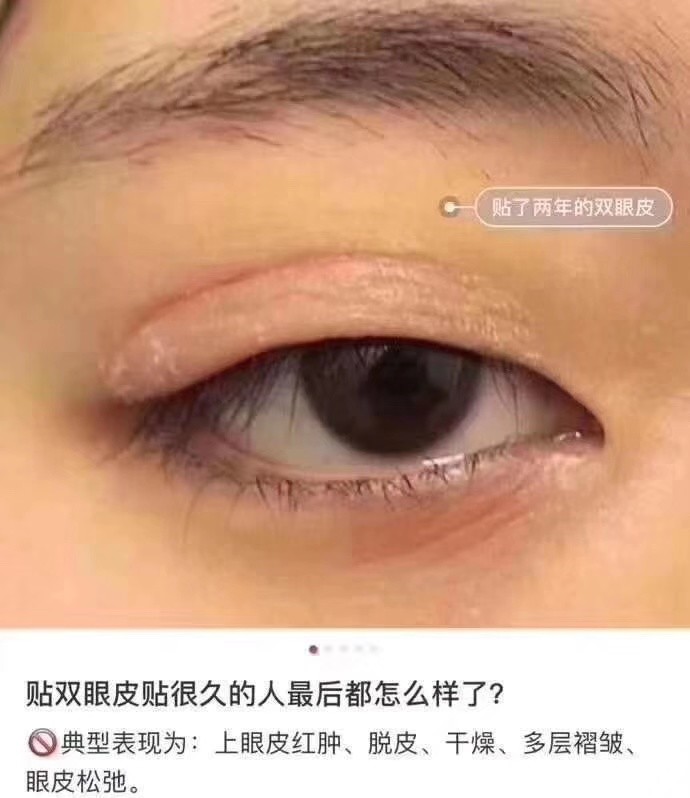 双眼皮可以贴出来么 新氧美容整形