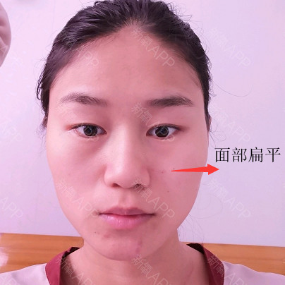 问题3:面中扁平