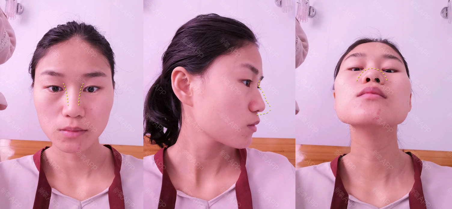 求看脸:头扁国字脸,面塌又凸嘴,能整成鞠婧祎吗?