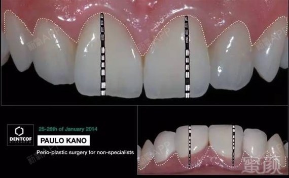 dsd微笑美学设计详细图解