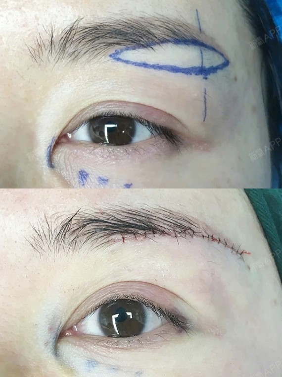 并不是每个人都适合,今天就给大家科普一些关于提眉术和切眉术的知识