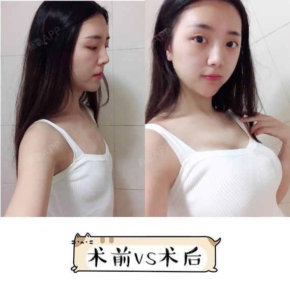 9399♀15假体隆胸一定会产生包膜挛缩7191丰胸是每个追