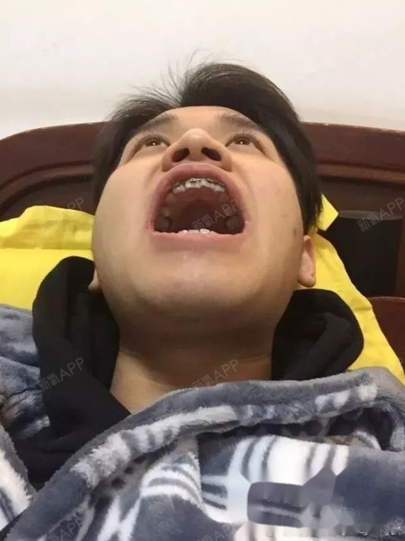 当上牙套哥已经323天,终于拉出了2号牙,等这一天_圈子-新氧美容整形