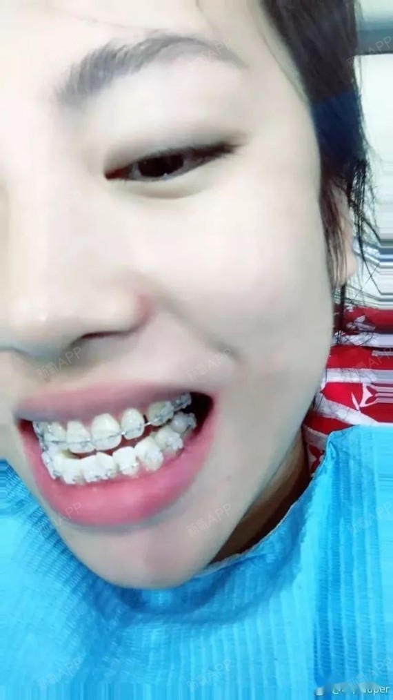 半隐形的牙套,能不能看出来呢?