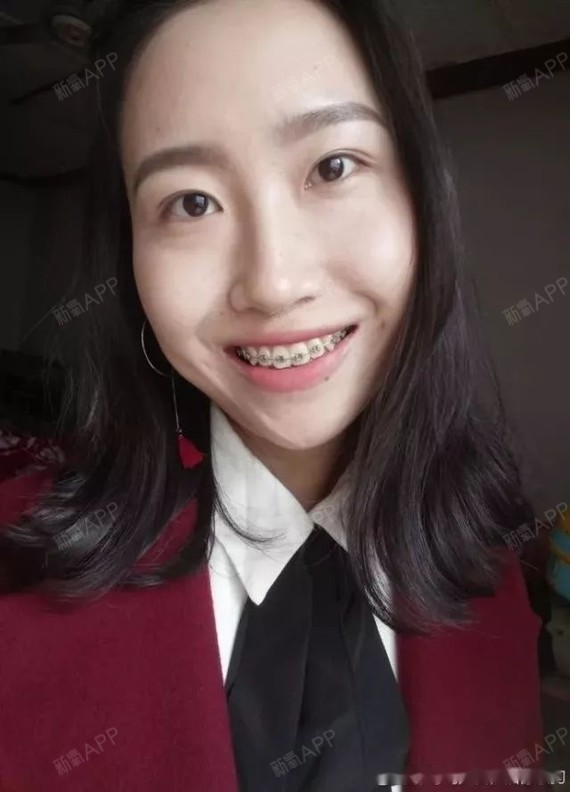 带牙套已经整整三个月啦,不对比不知道,翻出以前的照片,变化真的好大