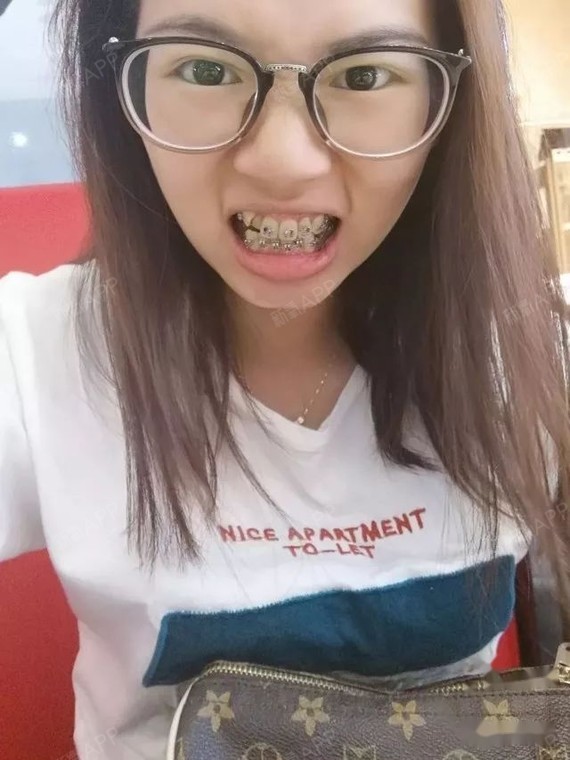 23岁的虎牙妹还是选择牙套不后悔