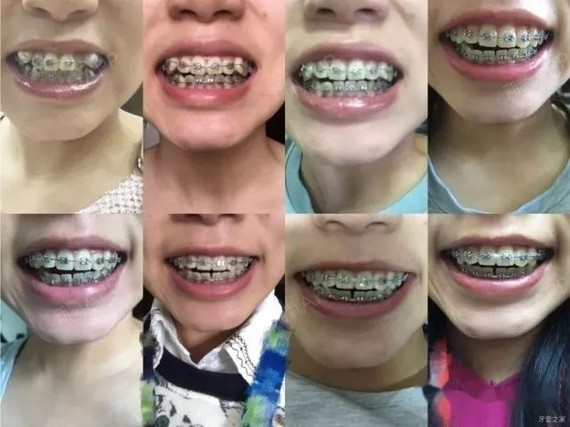 牙齿移动惊喜又感人,虎牙下来排齐了