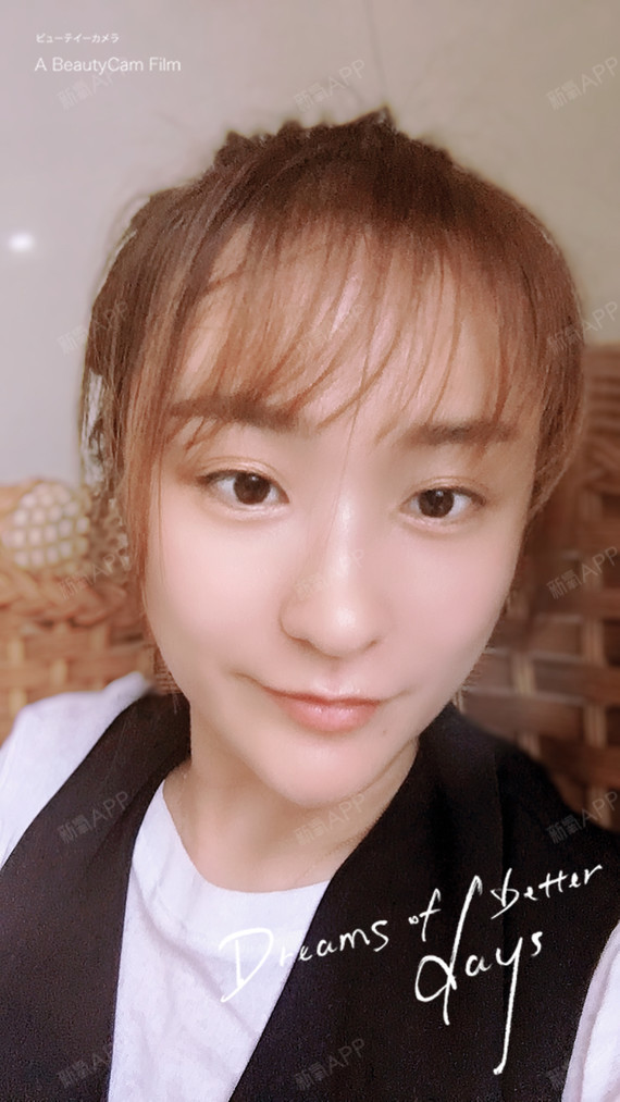 西安自体脂肪全脸填充好不好_效果图_氧气zsg8g自体脂肪全脸填充术后