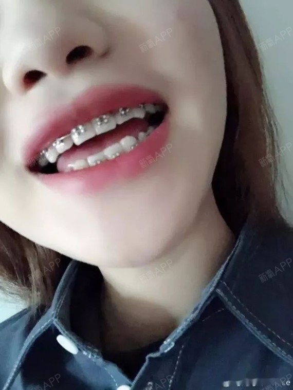 记录钢牙妹第171天 外带整牙前