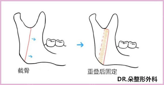 首页 此页面仅支持预览 Avatar 林赞洙 27篇日记 双鄂手术最终篇 固定式与非固定式 1 双鄂手术的固定式和非固定式的区别在面部轮廓手术里面也谈到过固定式和非固定式 双鄂手术也是和轮廓手术一样 分为固定式和非固定式手术 我们熟悉的固定式有 双鄂