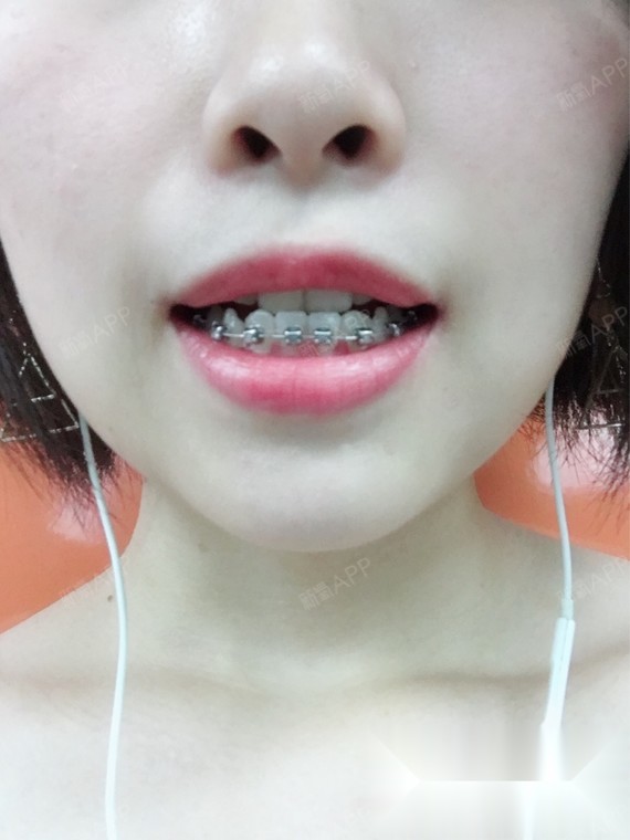 地包天 女 21岁 上颌虎牙特别突出 非遗传性 估_圈子-新氧美容整形