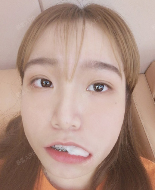 拔完牙后的我.有点肿肿的 有点可爱哈