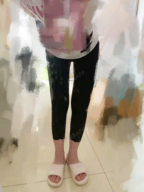 吸脂瘦手臂好不好_效果图_氧气237k0吸脂瘦手臂术后第7天_新氧美容