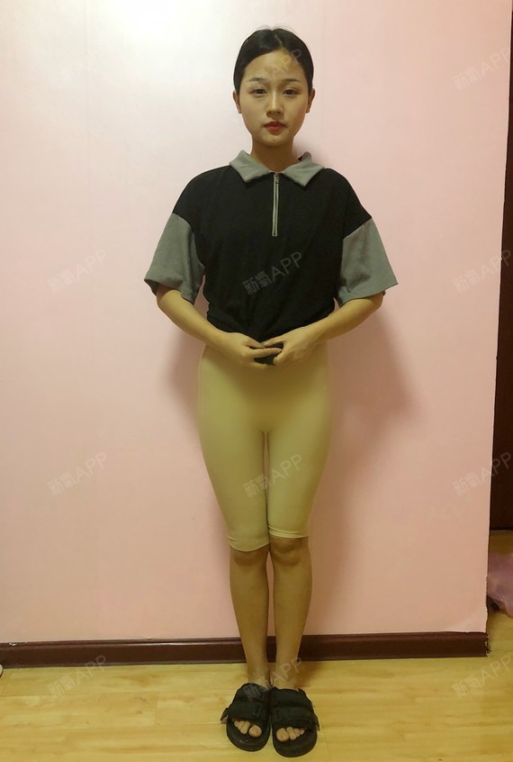 做完大腿吸脂也有大半个月了,现在每天24小时都在穿_圈子-新氧美容