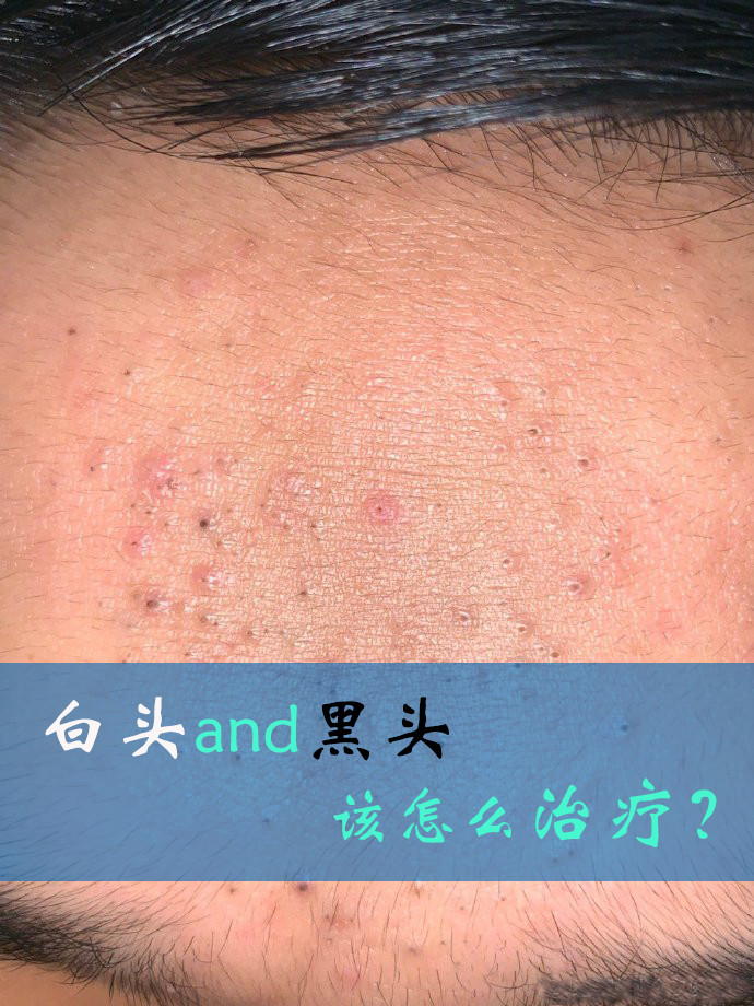 这是长在10来岁男孩额头的典型的黑头粉刺和白头粉刺,很多是黑头粉刺.