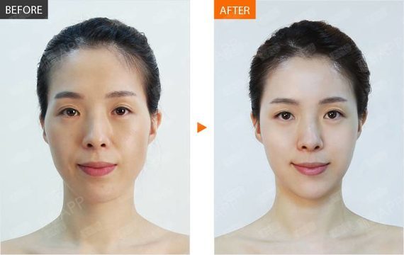 肉毒素是一种很常见的注射美容材料,尤其是在除皱瘦脸方面效果非凡,很