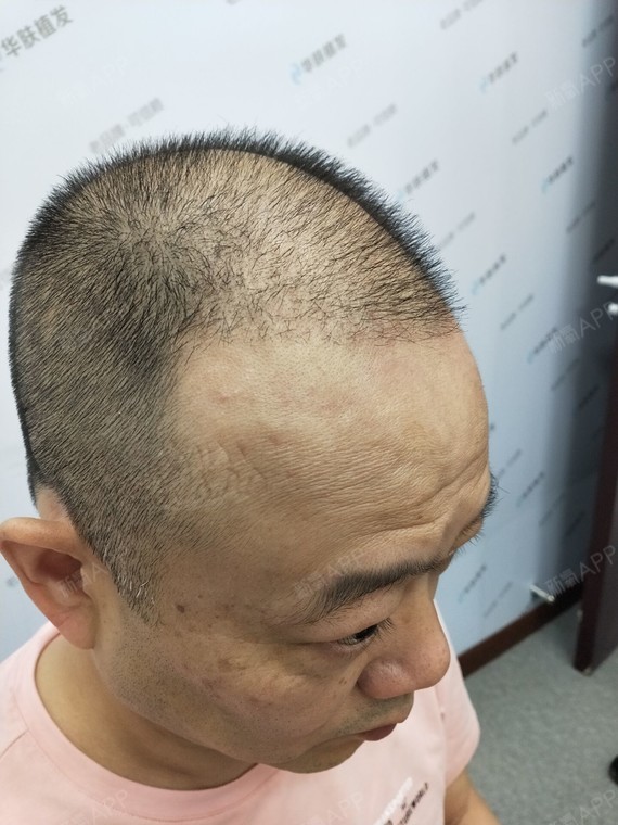 2个月了,感觉这两个月变化不大,医生说现在是置换期_圈子-新氧美容