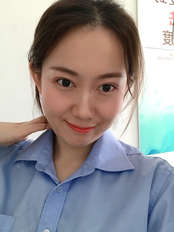 爱容双眼皮术后满一个月了
