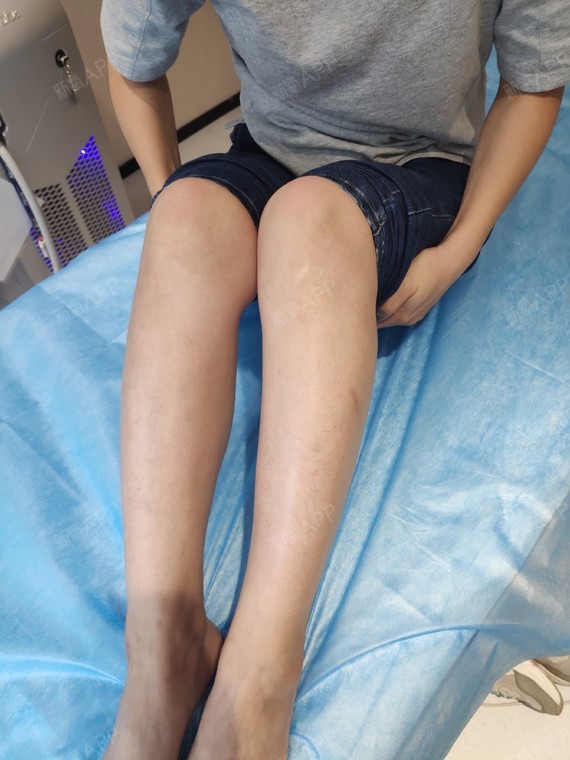 广州脱大小腿好不好_效果图_氧气bdkc23d脱大小腿术后第10天_新氧美容