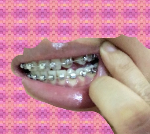 已经19年了,牙套当_圈子-新氧美容整形