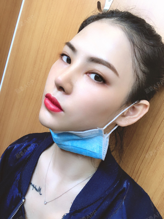 广西壮族自治区南宁超体隆鼻好不好_效果图_麦兜爱土豆超体隆鼻术后第