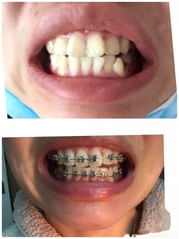 戴牙套收缝20天,橡皮链20天~感觉有变化啦