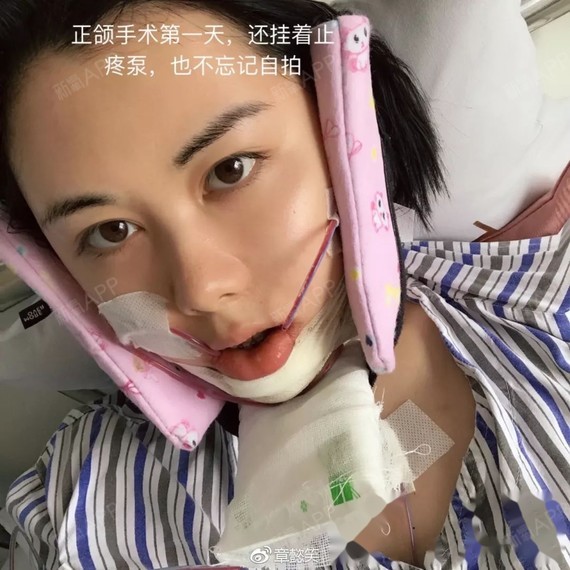 中线偏得厉害,咬合错位.二次矫正 正颌,再见了,钢铁龅牙妹