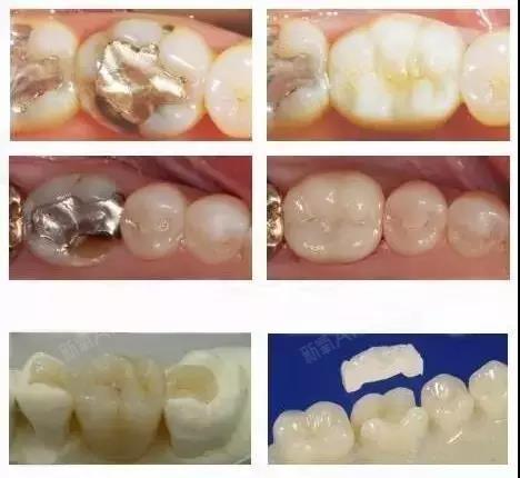 為什麼牙醫都推薦嵌體補牙
