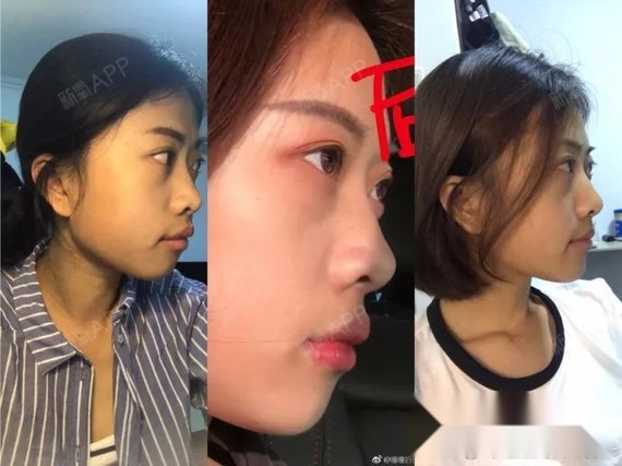 戴牙套一年三个月对比图