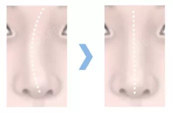 首页 此页面仅支持预览 Avatar 北京新面孔医疗美容诊所 240篇日记 歪鼻整形是按照歪鼻的原因 1对1的设计定制型手术计划 考虑整体和面部的协调以及客人喜欢的鼻子模样 不单纯是美的改善 连带肌能性的问题可以同时得到解决 注 X光面部平扫